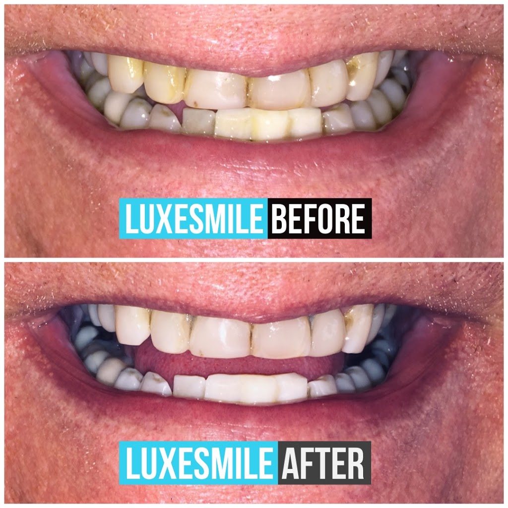 LuxeSmile | Teeth Whitening is all we do! | 22 Mill St S Unit 102, Waterdown, ON L0R 2H0, Canada | Phone: (905) 469-6093