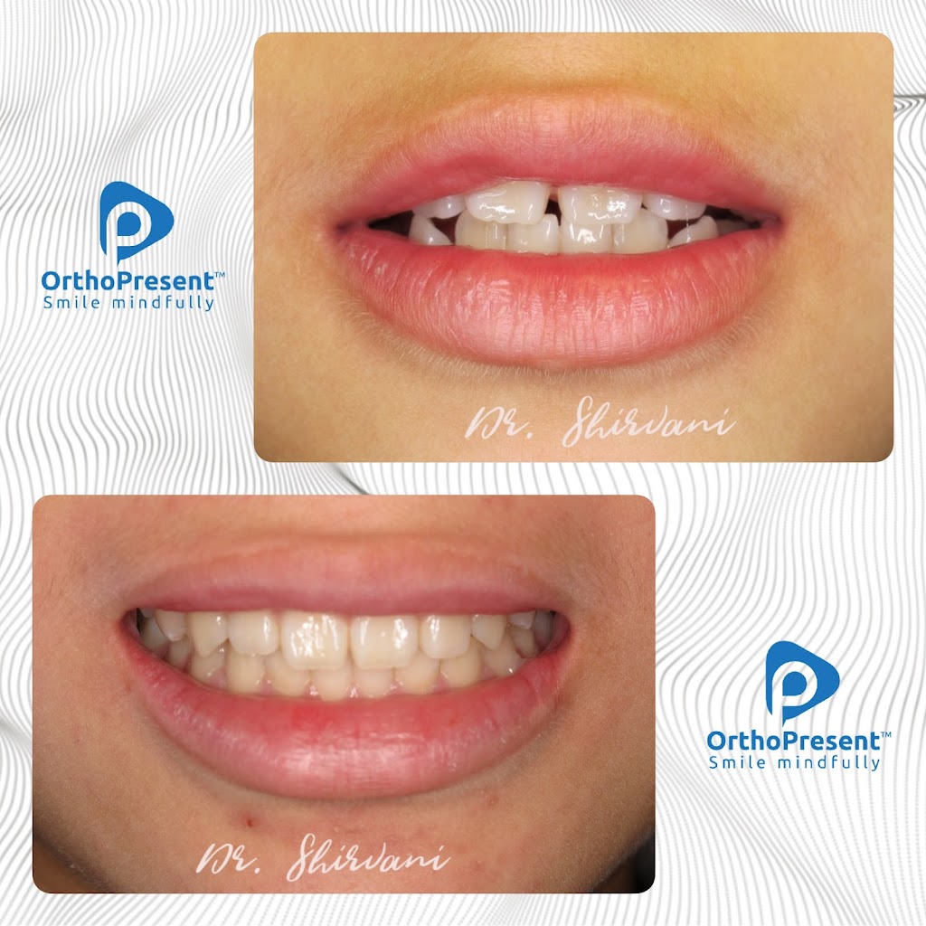 Phoenix Dental Implant and Invisalign Centre | 770 Kingsway, Vancouver, BC V5V 3C1, Canada | Phone: (604) 256-9619