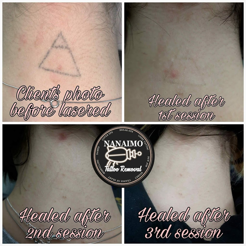 Nanaimo Tattoo Removal | 1925 Bowen Rd Unit #200, Nanaimo, BC V9S 1H1, Canada | Phone: (250) 327-7579