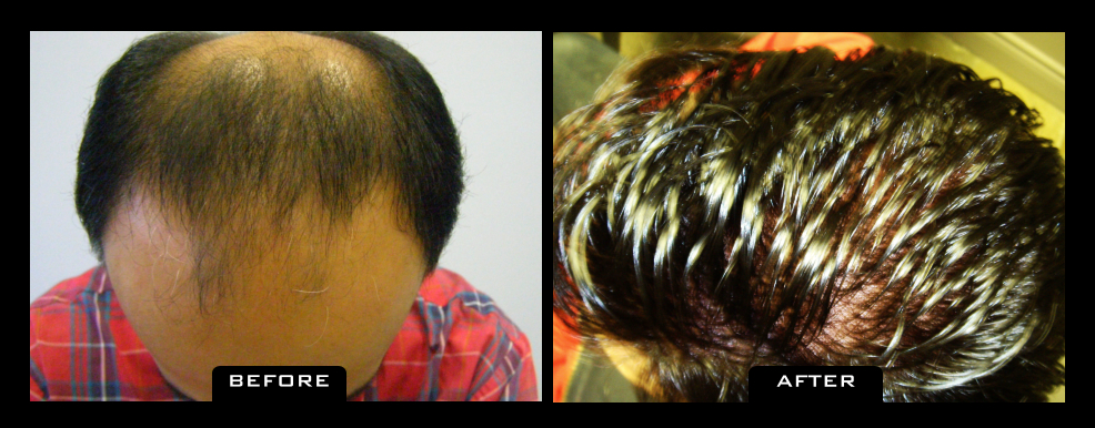 NuHair Medical Hair Transplant Centre | 5526 111 St NW, Edmonton, AB T6H 3E9, Canada | Phone: (587) 400-0344