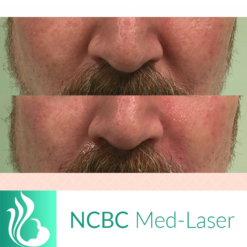 NCBC Med-Laser | 2090 Lawrence Ave E, Scarborough, ON M1R 2Z5, Canada | Phone: (416) 931-4772