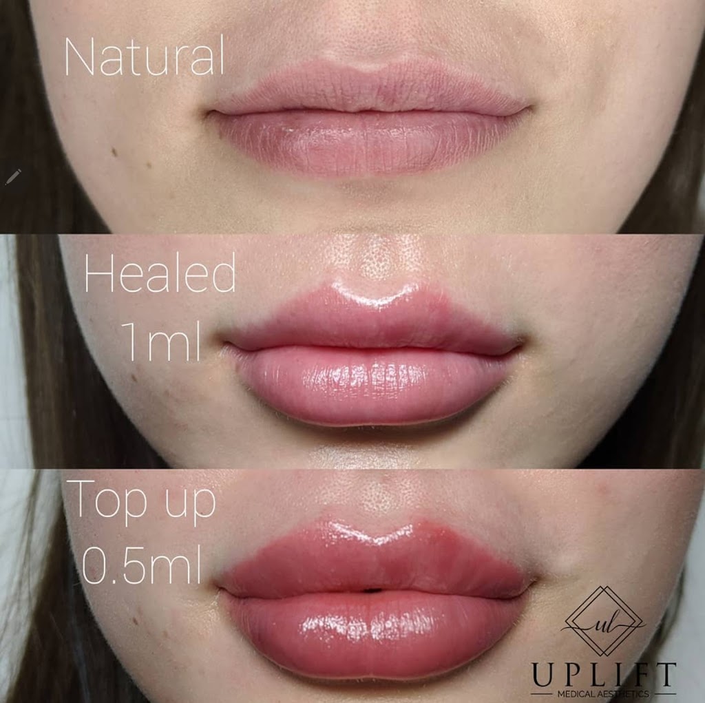 Uplift Medical Aesthetics | 2022 Main St N, Jarvis, ON N0A 1J0, Canada | Phone: (519) 420-9225