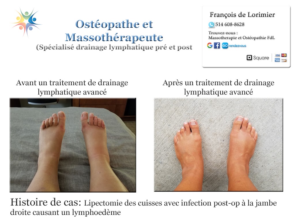 Massothérapie FdL Drainage lymphatique | Place Mercier, Candiac, QC J5R 4R5, Canada | Phone: (514) 608-8628