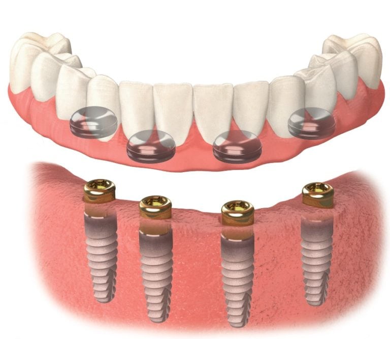 Ayad Yousif Denturist | 5220 Dundas St Unite #6, Burlington, ON L7R 3X4, Canada | Phone: (647) 779-6318