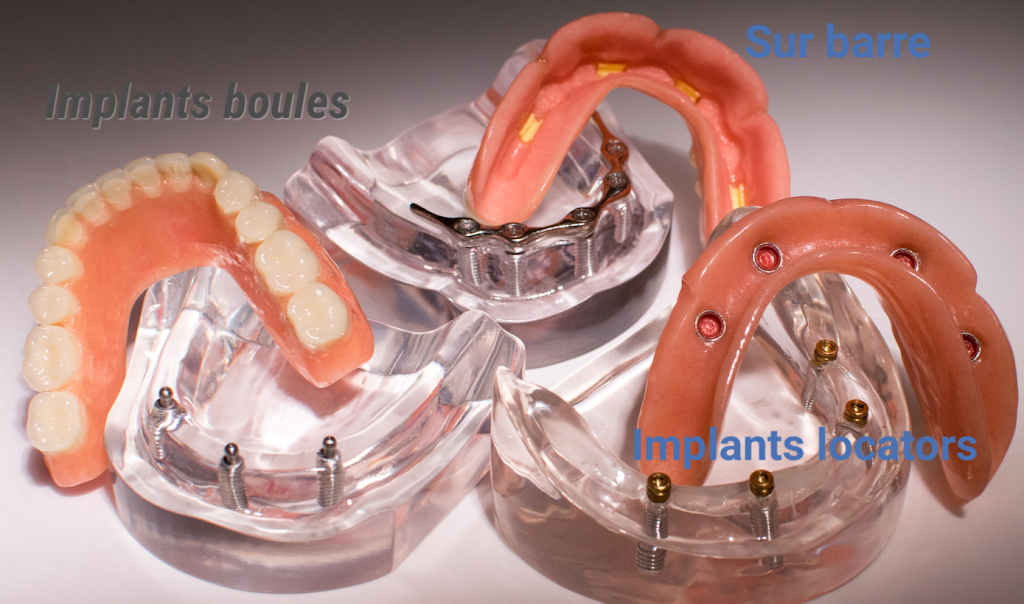 Denturologiste Saint Laurent | Prothèses dentaires Mon Sourire | 2505 Rue des Nations, Saint-Laurent, QC H4R 3C8, Canada | Phone: (514) 333-3368