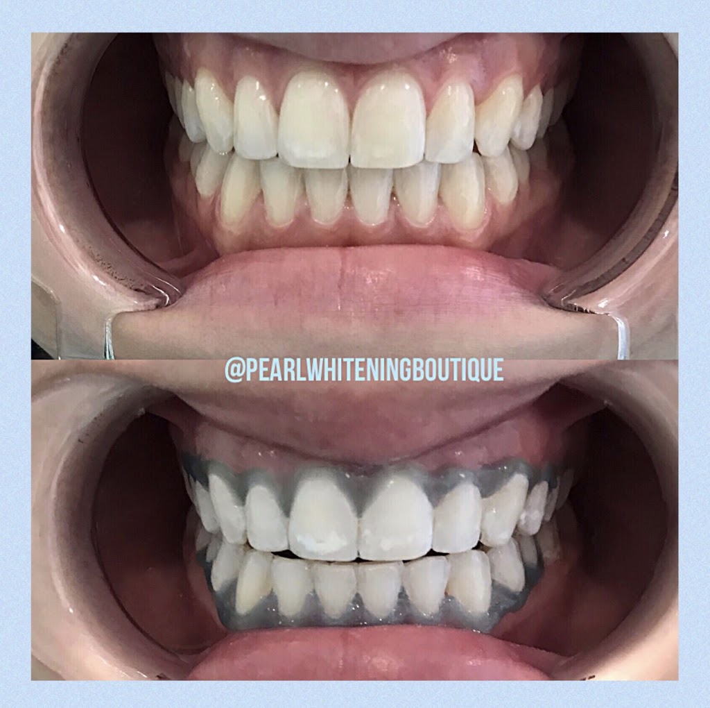 Pearl Whitening Boutique - Teeth Whitening Toronto, Laser Teeth  | 1179 The Queensway, Etobicoke, ON M8Z 1T3, Canada | Phone: (647) 883-5220