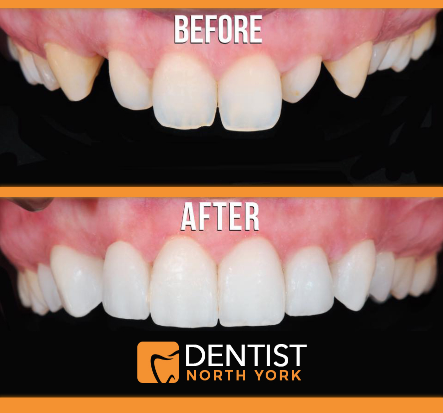 Dentist North York | 1800 Sheppard Ave E Suite 1042, North York, ON M2J 5A7, Canada | Phone: (416) 494-3868