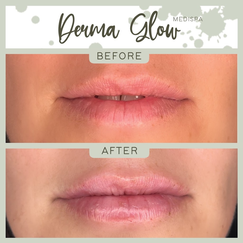 Derma Glow Medispa | 1389 Wallbridge Loyalist Rd, Belleville, ON K8N 4Z5, Canada | Phone: (613) 885-2804