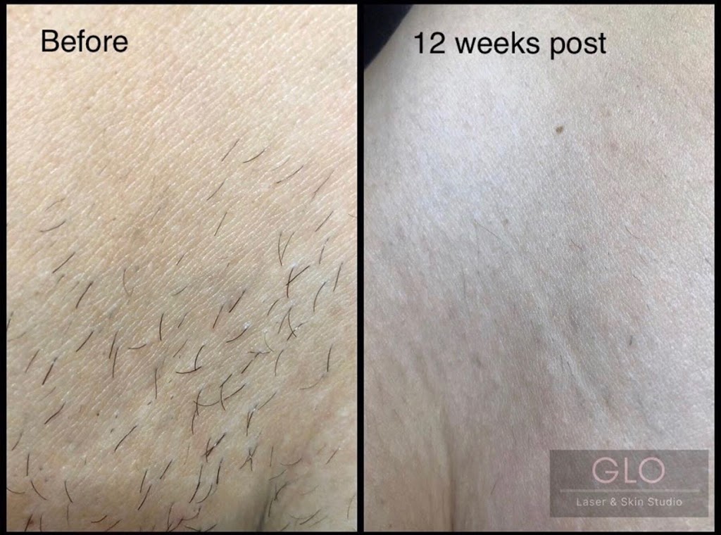 GLO Laser & Skin Studio | 7500 York Regional Rd 27 Unit 26, Vaughan, ON L4H 0J2, Canada | Phone: (905) 605-4566