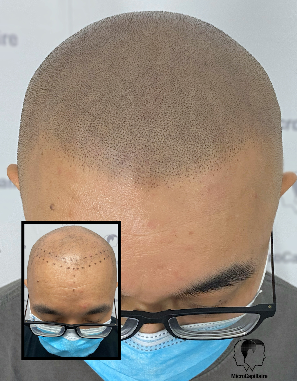 Clinique MicroCapillaire - Scalp Micropigmentation Capillaire | 2884 Chemin de Chambly, Longueuil, QC J4L 1G7, Canada | Phone: (450) 679-1888