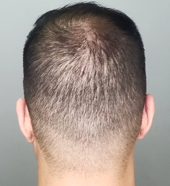 Scalp Micropigmentation by Chronic Ink - Markham | 7381 Kennedy Rd Unit #105, Markham, ON L3R 5B5, Canada | Phone: (905) 305-0311