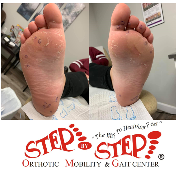 Step By Step Orthotic Mobility & Gait Center | 116 Pinnacle St 1st Floor suite 1, Belleville, ON K8N 3A4, Canada | Phone: (613) 902-5001