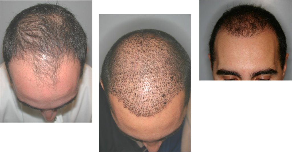 Buffalo Hair Transplant Center | 5007 Transit Rd Suite #2, Depew, NY 14043, USA | Phone: (716) 226-1020