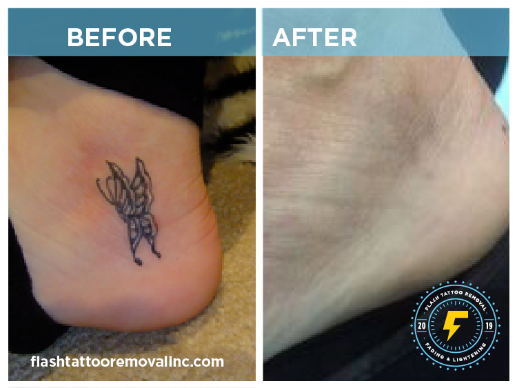 FLASH Tattoo Removal Calgary | 1530 9 Ave SE, Calgary, AB T2G 0T7, Canada | Phone: (403) 978-5488