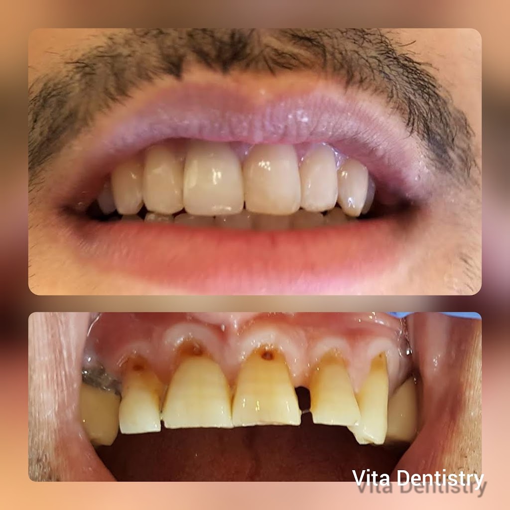 Vita Dentistry | 879 York Mills Rd Unit 6, North York, ON M3B 1Y5, Canada | Phone: (647) 276-0076