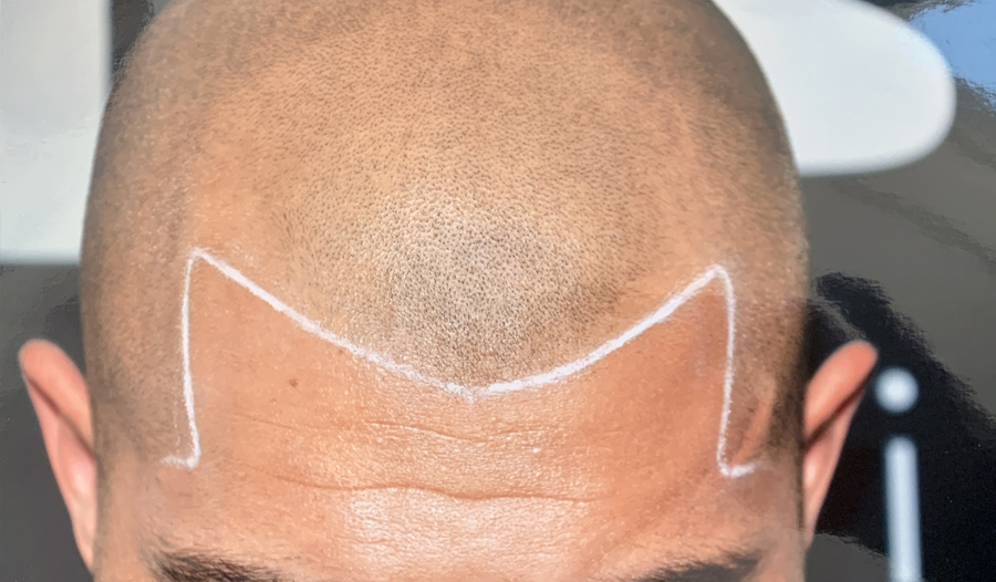 TRICHOLOGY CENTRE | Hair Loss and SMP Scalp Micropigmentation Ri | 9140 Leslie St Unit 301, Richmond Hill, ON L4B 3L6, Canada | Phone: (647) 492-9093