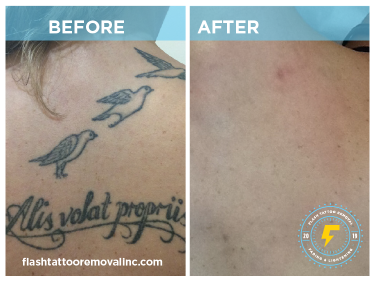 FLASH Tattoo Removal Calgary | 1530 9 Ave SE, Calgary, AB T2G 0T7, Canada | Phone: (403) 978-5488