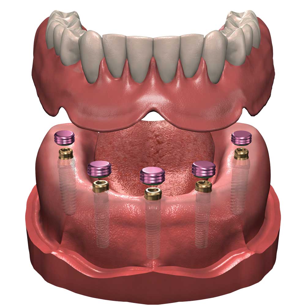 Denturologie Mon Sourire I Denturologiste Saint Laurent | 2505 Rue des Nations, Saint-Laurent, QC H4R 3C8, Canada | Phone: (514) 506-4983