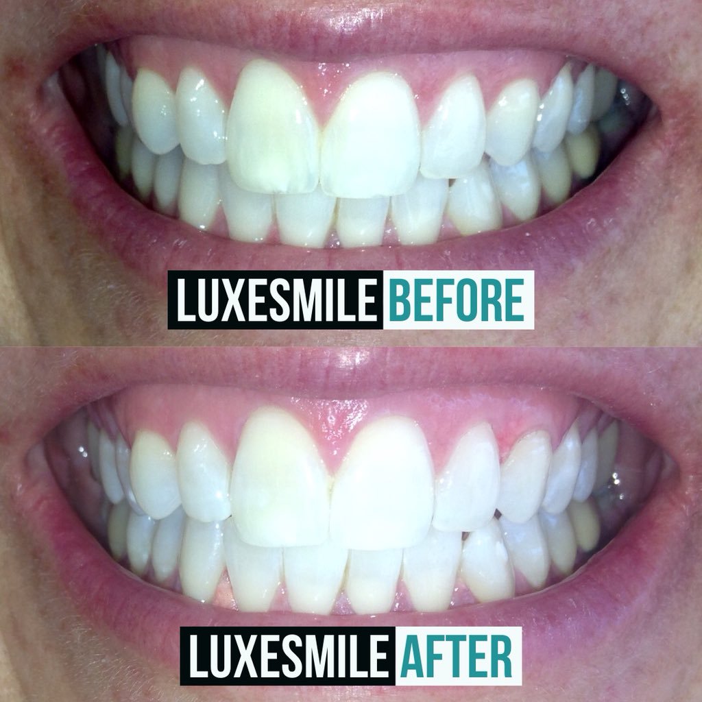 LuxeSmile | Teeth Whitening is all we do! | 3455 Fairview St, Burlington, ON L7N 2R4, Canada | Phone: (905) 469-6093