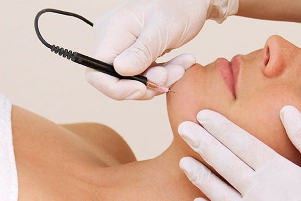 Victoria Permanent Hair Removal | 2186 Oak Bay Ave #202, Victoria, BC V8R 1G3, Canada | Phone: (778) 700-2398