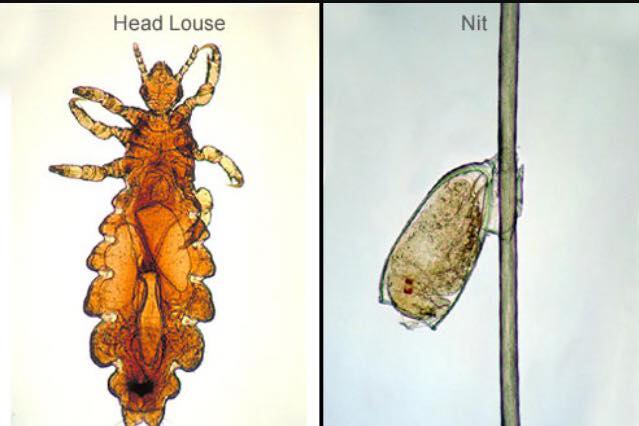 Lice Buster | 99 Maple St, Guelph, ON N1G 2G5, Canada | Phone: (647) 949-5423