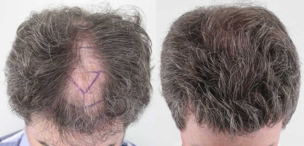 Rahal Hair Transplant Toronto | 1131 Leslie St #300, North York, ON M3C 3L8, Canada | Phone: (647) 559-2811