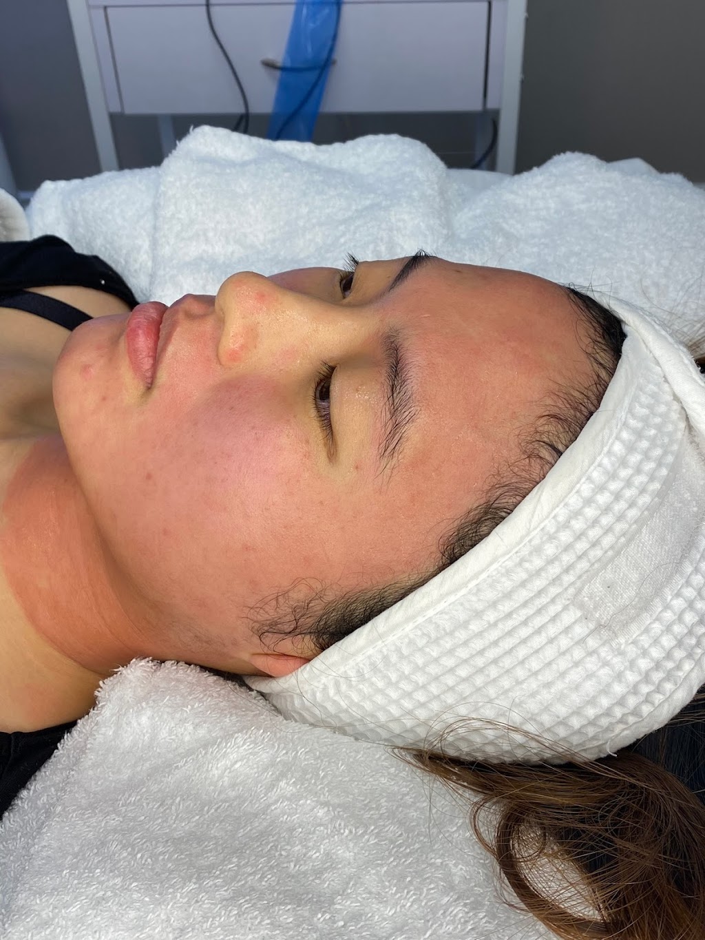 Arga Light Laser& Skin Care | 3059 Timber Ct, Coquitlam, BC V3E 2Y8, Canada | Phone: (604) 838-8445