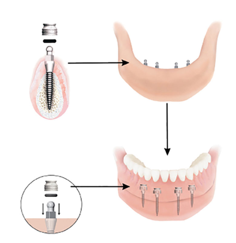 Dental Implant Solutions of Eden, NY | 2763 W Church St #1, Eden, NY 14057, USA | Phone: (716) 226-0806