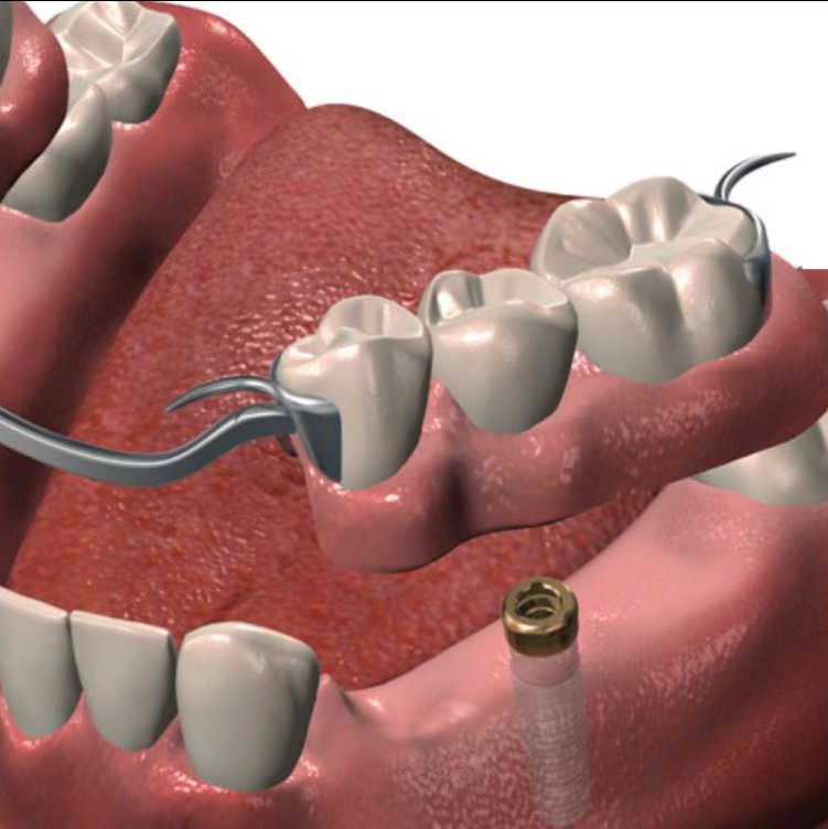 Denturologiste Saint Laurent | Prothèses dentaires Mon Sourire | 2505 Rue des Nations, Saint-Laurent, QC H4R 3C8, Canada | Phone: (514) 333-3368