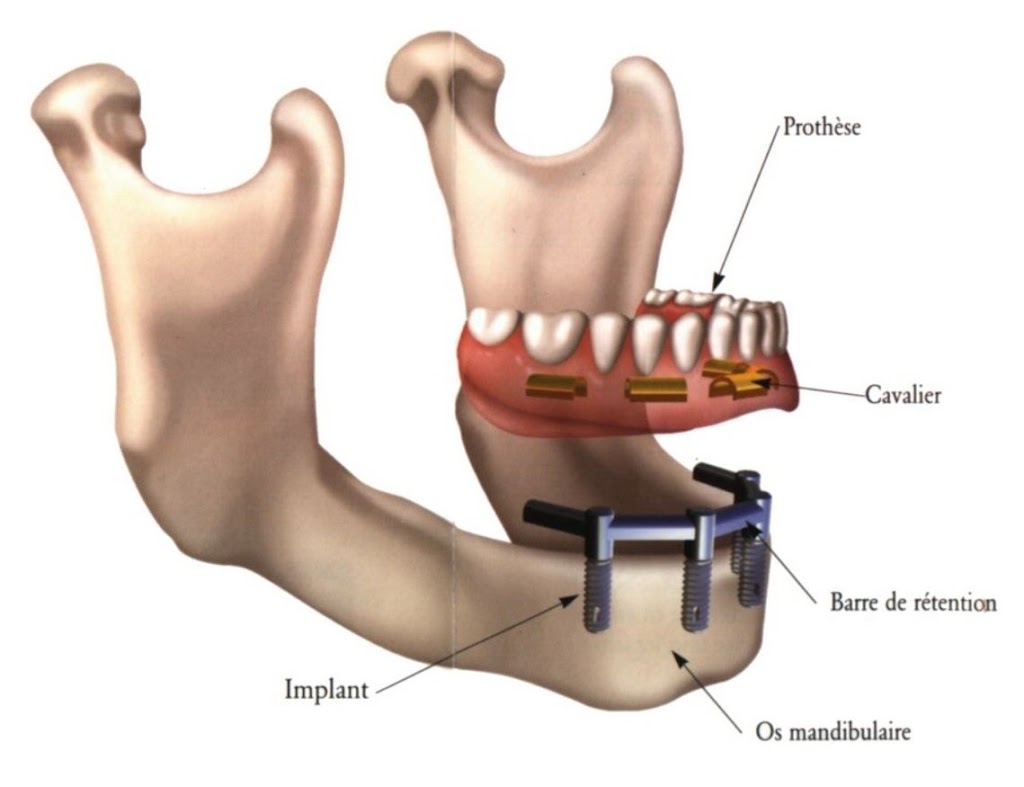 Denturologie Mon Sourire I denturologiste Saint-Eustache | 187 Bd Arthur-Sauvé bureau 1, Saint-Eustache, QC J7P 2A6, Canada | Phone: (450) 472-4044