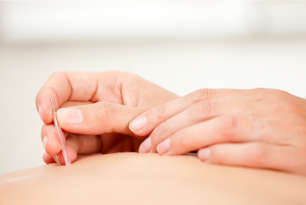 Balance To Heal Acupuncture | 304 Cranberry Park SE unit 202, Calgary, AB T3M 1W2, Canada | Phone: (705) 500-6601