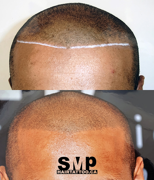 SMP® Scalp Micropigmentation Richmond Hill | HAIRTATTOO.CA | 9140 Leslie St #301, Richmond Hill, ON L4B 3L6, Canada | Phone: (647) 492-9093