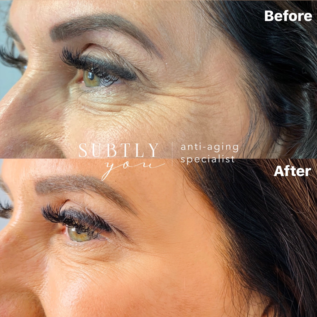 Subtly You - Kitchener Anti-Aging Medical Cosmetic Injections | 40 Benesfort Dr, Kitchener, ON N2N 3B6, Canada | Phone: (519) 994-1387