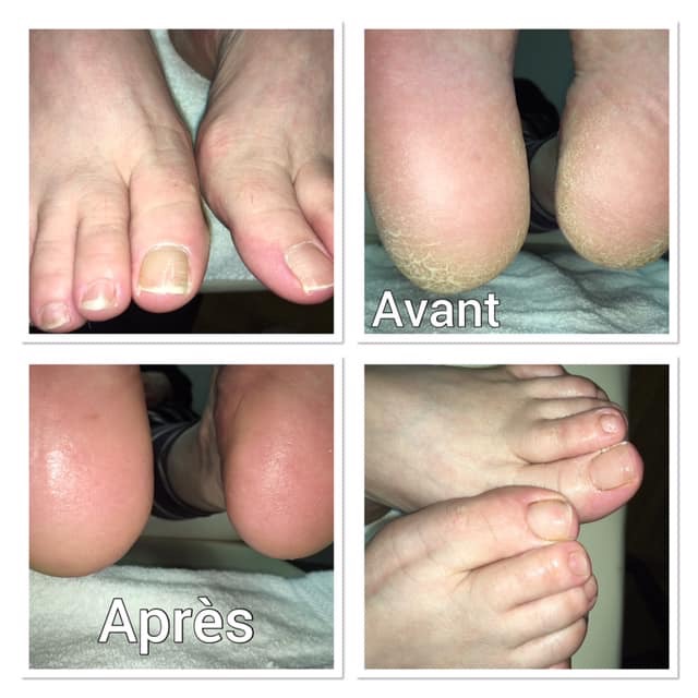 Soin des pieds Vanessa Perron infirmière auxiliaire | 15600 Grand rang Saint-François, Saint-Hyacinthe, QC J2T 5H1, Canada | Phone: (450) 502-4888