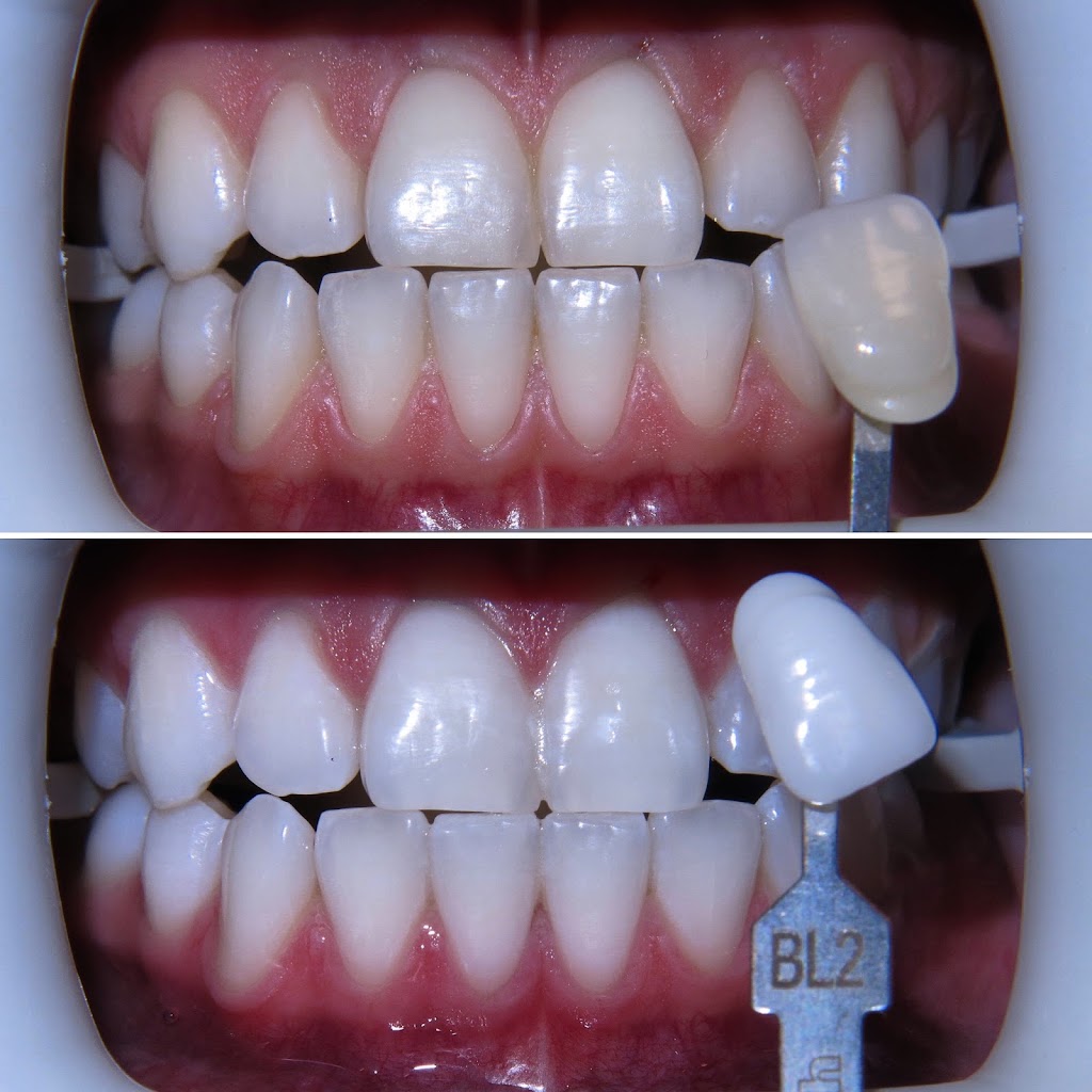 Dr Arun Narang & Associates Smile by Design | 3038 Hurontario St #4, Mississauga, ON L5B 3B9, Canada | Phone: (905) 897-1166