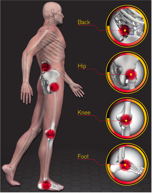 Bow Valley Custom Orthotics | 5700 Falconridge Dr NE, Calgary, AB T3J 3H4, Canada | Phone: (403) 351-5585