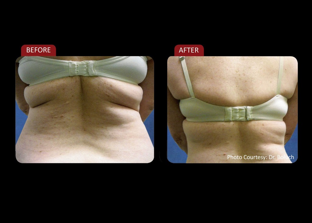 Global Laser Body Contouring | 208-269 Boul Saint-Jean, Pointe-Claire, QC H9R 3J1, Canada | Phone: (514) 619-2575