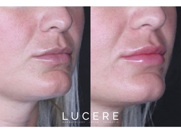 Lucere Dermatology and Laser Clinic | 625 Parsons Rd SW #113, Edmonton, AB T6X 0N9, Canada | Phone: (780) 461-1188