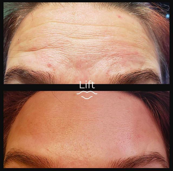 Lift Clinic Toronto | Botox | Fillers | 66 Portland St #101, Toronto, ON M5V 2M6, Canada | Phone: (647) 831-9060