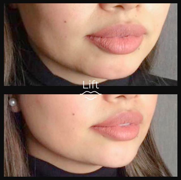 Lift Clinic Toronto | Botox | Fillers | 66 Portland St #101, Toronto, ON M5V 2M6, Canada | Phone: (647) 831-9060