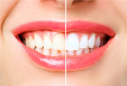 White Smiles | 9832 204 St, Langley City, BC V1M 0A6, Canada | Phone: (604) 879-9099