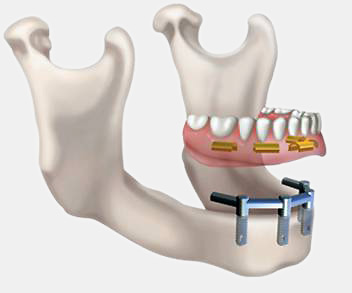 Denturologistes du Quartier - St-Bruno | 47 Chem. de la Rabastalière E #101, Saint-Bruno-de-Montarville, QC J3V 2A4, Canada | Phone: (450) 441-3636