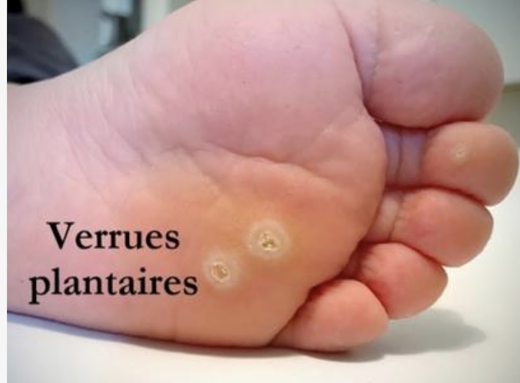 Clinique de soins de pieds/soins infirmiers Beauport | 202 Avenue St Michel, Québec, QC G1C 1G1, Canada | Phone: (418) 265-9447