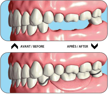 Denturologistes Cartierville | 5995 Boul Gouin O Suite 202, Montréal, QC H4J 2P8, Canada | Phone: (514) 336-8486