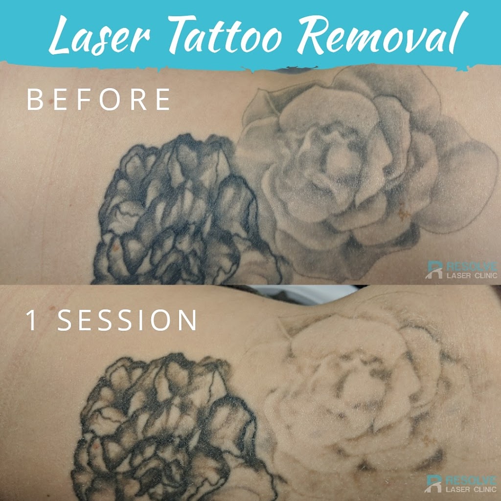 Resolve Laser Clinic | 3502 Taylor St E #106A, Saskatoon, SK S7H 5H9, Canada | Phone: (306) 612-3773