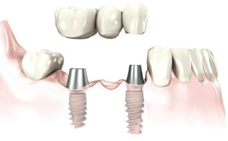 Centre dimplantologie Pierre Martin - Québec | 750 Rue Saint-Vallier O, Québec, QC G1N 1E1, Canada | Phone: (418) 684-7644