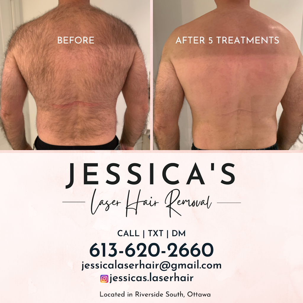 Jessicas Laser Hair Removal | 658 Bowercrest Crescent, Gloucester, ON K1V 2L6, Canada | Phone: (613) 620-2660