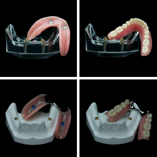 Implant Dentures | 18 Church St, Georgetown, ON L7G 2A5, Canada | Phone: (905) 877-2359