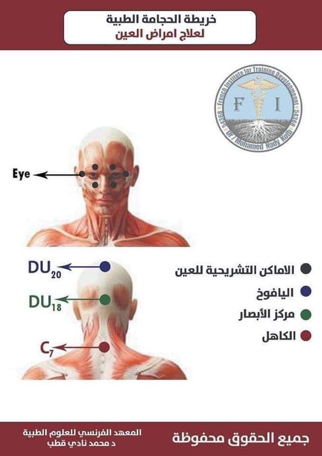 Hijama montreal clinic | 5805 Rue Lauzon, Montréal-Nord, QC H1G 2G9, Canada | Phone: (438) 221-5070