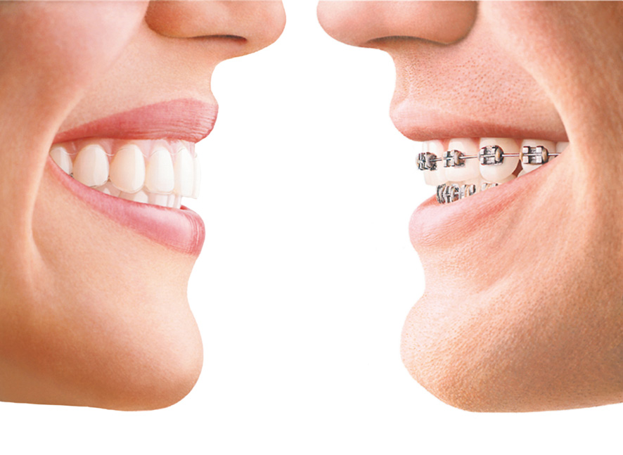 Invisalign Clinic | 55 Ipswich Crescent, North York, ON M2J 3N4, Canada | Phone: (416) 977-0123